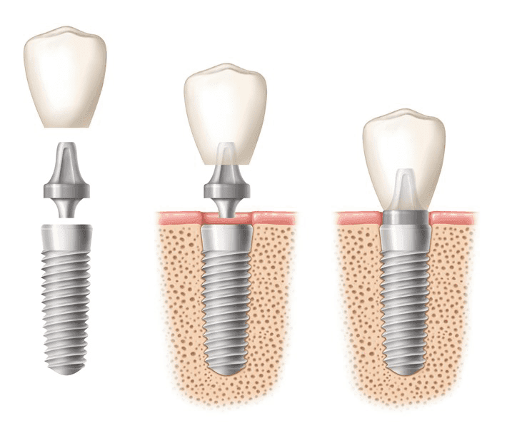 Proceso de colocación de implantes dentales en Avilés Digital Dental Clinic, desde el tornillo hasta la corona definitiva, ideal para tratamientos de implantes dentales en Fuengirola con carga inmediata.