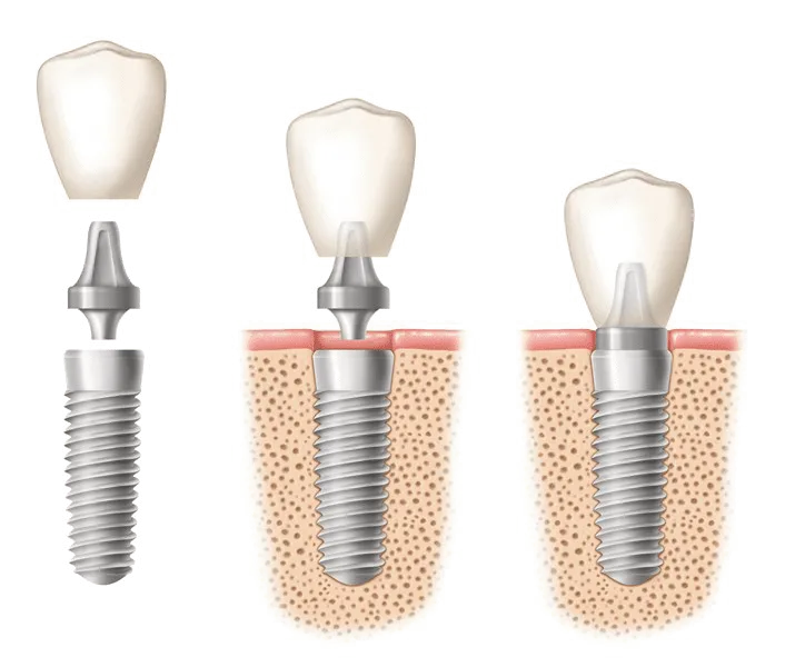 Proceso de colocación de implantes dentales en Avilés Digital Dental Clinic, desde el tornillo hasta la corona definitiva, ideal para tratamientos de implantes dentales en Fuengirola con carga inmediata.
