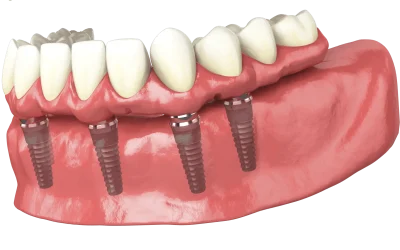 All on 4 Illustration of an All on 4 dental prosthesis by Avilés Digital Dental Clinic in Fuengirola with four implants in the lower jaw.